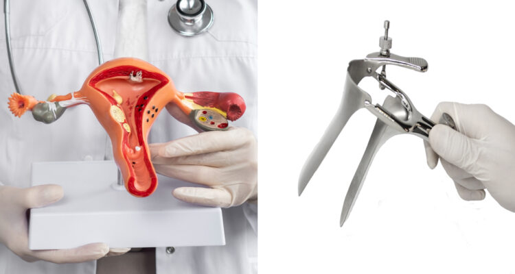Imagen de un útero y un espéculo que se usa para el examen Papanicolau