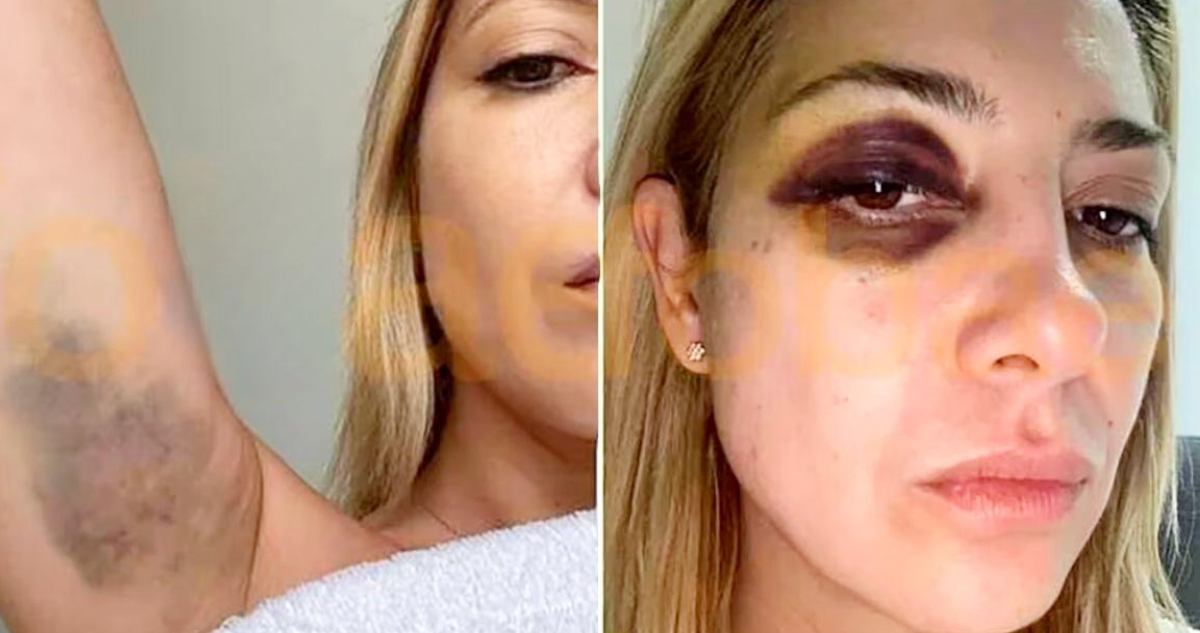 Revelan fotos de hematomas de Fabiola Yañez tras denuncia por violencia contra Alberto Fernández