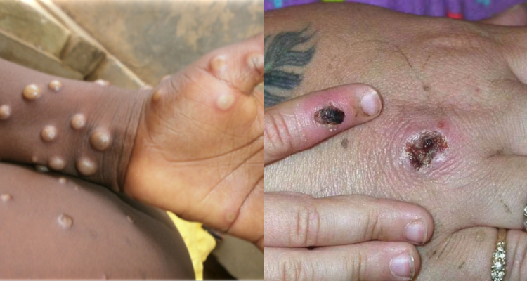 Cuáles son los primeros síntomas de la viruela del mono: ¿Tiene cura y cómo se contagia?