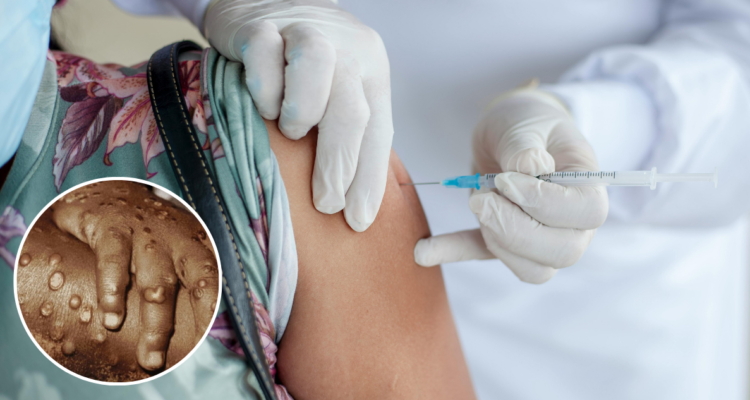 Este pasado domingo, el director general de la OMS, Tedros Adhanom, emitió una declaración pública donde señaló que la cepa mpox, la más mortal de la viruela del mono, se está propagando por países africanos. “A medida que una cepa más mortal de la viruela del mono (mpox) se propaga a múltiples países africanos, la OMS, el Centro para el Control de Enfermedades y Prevención de África (Africa CDC), los gobiernos locales y sus socios están intensificando la respuesta para interrumpir la transmisión de la enfermedad”, manifestó Adhanom. “Sin embargo, se necesitan más fondos y apoyo para una respuesta integral. [destacador]Estoy considerando convocar un Comité de Emergencia del Reglamento Sanitario Internacional para que me asesore sobre si el brote de viruela del mono debería ser declarado una emergencia de salud pública de preocupación internacional[/destacador]“, agregó. Preocupación por mpox: la nueva cepa más mortal de la viruela del mono Actualmente, España es el país europeo con más notificaciones de mpox desde que estallara el gran brote de viruela del mono en abril de 2022, con un total de 8.101 casos. De tal cifra total, 260 casos se han confirmado en lo que va de este año (casi la mitad en Madrid), de los que prácticamente el 90% no estaba vacunado. [LeeTambien]https://www.biobiochile.cl/noticias/salud-y-bienestar/vida-fitness/2024/08/07/ricezempic-hay-alguna-evidencia-de-que-esta-tendencia-de-tiktok-ayude-a-perder-peso.shtml[/LeeTambien] De ellos, 16 se han producido entre el 5 de julio y el 5 de agosto, según el último “Informe de situación epidemiológica de los casos de infección por mpox en España” del Centro Nacional de Epidemiología del Instituto Carlos III. Nuevo brotes de mpox Aunque los nuevos contagios se concentraron en enero y febrero, el Ministerio de Sanidad de España ha señalado que hay que tener en cuenta los retrasos en la notificación. La misma entidad gubernamental advirtió que “la transmisión de mpox se mantiene y es sostenida”. [destacador]“La transmisión se mantiene y es sostenida; y en cualquier momento, si no se protegen las personas con mayor riesgo, pueden acumularse las personas susceptibles y desencadenar nuevos brotes”[/destacador], añadieron desde el Ministerio. [LeeTambien]https://www.biobiochile.cl/noticias/salud-y-bienestar/cuerpo/2024/08/06/pasar-agosto-mito-o-realidad-geriatra-explica-el-dicho-y-brinda-consejos-para-los-adultos-mayores.shtml[/LeeTambien] Atendiendo a los últimos datos del Centro Europeo para la Prevención y el Control de Enfermedades (ECDC, por sus siglas en ingles), España es el país con más casos diagnosticados, casi el doble que el siguiente, que es Francia. Los datos corresponden al mes de junio, fecha en la que España había reportado [destacador]8.084 contagios, frente a los 4.272 de Francia[/destacador]. De los nuevos casos, los reportados por España suponían un tercio de los comunicados por 42 países europeos (124 de un total de 349 en el segundo trimestre de 2024). Forma de contagio y sintomatología Casi la totalidad (98 %) de los nuevos contagios en España se dieron en hombres de entre 6 y 68 años, aunque seis de cada diez tenía entre 30 y 49, con lo que la mediana de edad fue de 37. Más de la mitad ha nacido en España y un 30% en Latinoamérica. [LeeTambien]https://www.biobiochile.cl/noticias/salud-y-bienestar/cuerpo/2024/08/05/en-que-consiste-un-shock-anafilactico-por-alergia-alimentaria-y-como-reconocerlo.shtml[/LeeTambien] Tres de cada cuatro presentó sintomatología general, como [destacador]fiebre (el más frecuente), astenia (fatiga), dolor de garganta, muscular o cefalea y casi la mitad desarrolló linfadenopatías localizadas (inflamación de los ganglios linfáticos)[/destacador]. El exantema (tipo de erupción cutánea) en la zona anogenital apareció en el 76,1 % de los casos, en la zona oral bucal en el 17,4%, y en otras localizaciones en el 53% de los casos. El 13% desarrolló complicaciones como infecciones bacterianas secundarias, úlceras bucales o infecciones corneales. Un tercio tenía VIH. Doce pacientes tuvieron que ser ingresados, todos hombres, con una mediana de edad de 30,5 años. Las relaciones sexuales se mantienen como la principal vía de transmisión probable: es como se infectaron el 80% de los casos de este año, mientras que el 4,9% se expuso fuera de este contexto y del 15,8% restante no se tiene información. Excluyendo el caso del menor de 6 años, 190 eran hombres que habían tenido relaciones sexuales con otros hombres, 6 eran hombres heterosexuales, 5 mujeres heterosexuales y en 48 sujetos no constaba este dato. EFE Verifica detalla que la viruela del mono es una enfermedad infecciosa causada por un virus procedente de África Central y Occidental que cursa con diferentes síntomas leves, especialmente una erupción cutánea que comienza en la cara y se extiende por el resto del cuerpo. Se trata de un “ortopoxvirus”, el cual infecta a animales como roedores (los hospedadores del virus), y provoca brotes en primates y, con baja frecuencia, en humanos. El virus tiene un periodo de incubación de entre 5 y 21 días, siendo en la mayoría de los casos entre 7 y 14 días. Los síntomas son fiebre, dolores de cabeza, musculares y de espalda, escalofríos y agotamiento, además de inflamación de los ganglios como se detalló anteriormente, además de la erupción que comienza en la cara y se extiende a otras partes del cuerpo, principalmente manos y pies. La viruela del mono se trata de una patología de baja transmisión. El contagio de persona a persona se produce a través de saliva o excreciones respiratorias, o por contacto con el exudado de la lesión o el material de la costra. También a través de heces, así como en las relaciones sexuales, sin que se trate expresamente de una enfermedad de transmisión sexual. La Sociedad Española de Medicina de Urgencias y Emergencias (SEMES) considera que la transmisión entre humanos es escasa y requiere de un contacto estrecho. Por su lado, la Sociedad Española de Enfermedades Infecciosas y Microbiología Clínica (SEIMC), explica que [destacador]aún desconoce cual va a ser la evolución epidemiológica de la viruela del mono y aconseja a los que tengan dudas sobre una posible infección que consulten a su centro médico de referencia para tomar las decisiones de diagnóstico terapéuticas oportunas[/destacador]. [LeeTambien]https://www.biobiochile.cl/noticias/ciencia-y-tecnologia/ciencia/2024/08/03/cientificos-desarrollan-nuevos-examenes-de-sangre-que-detectarian-alzheimer-con-un-90-de-precision.shtml[/LeeTambien] La enfermedad puede durar entre 2 y 4 semanas hasta una completa recuperación para la mayoría de personas. No obstante, las personas inmunodeprimidas pueden sufrir complicaciones como dificultad respiratoria, infecciones bacterianas secundarias y encefalitis. Los pacientes deben aislarse mediante el uso de mascarilla quirúrgica y permanecer en una habitación individual. Se cubrirá cualquier lesión en superficie corporal. El paciente es contagioso hasta que todas las costras han caído.