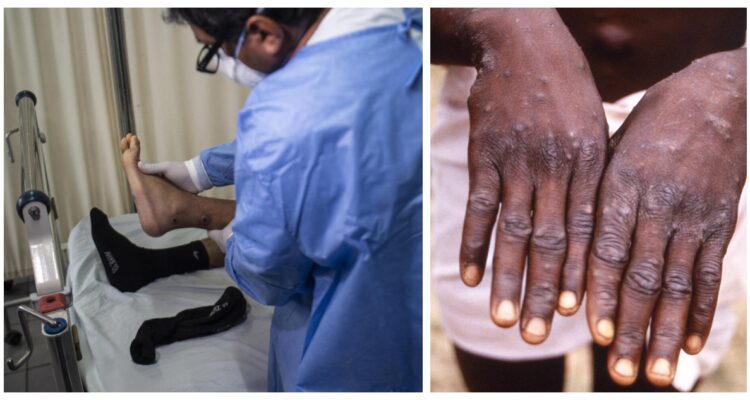 Un tipo de viruela del mono fue detectado en África Central, siendo más mortífero y con tasas de mortalidad de hasta el 10%.