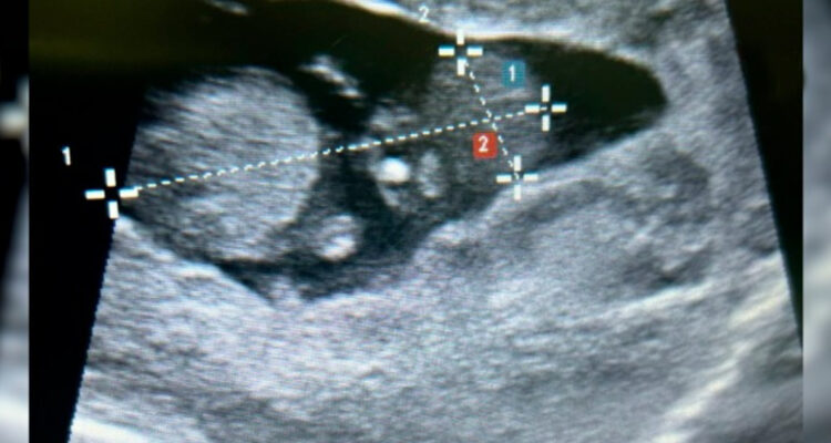Embarazo ectópico alojado en el hígado