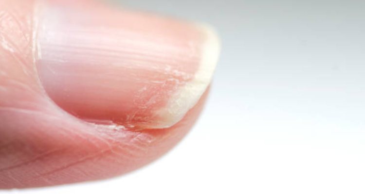 ¿Cómo saber si tengo hongos en las uñas y qué debería hacer para eliminarlos?