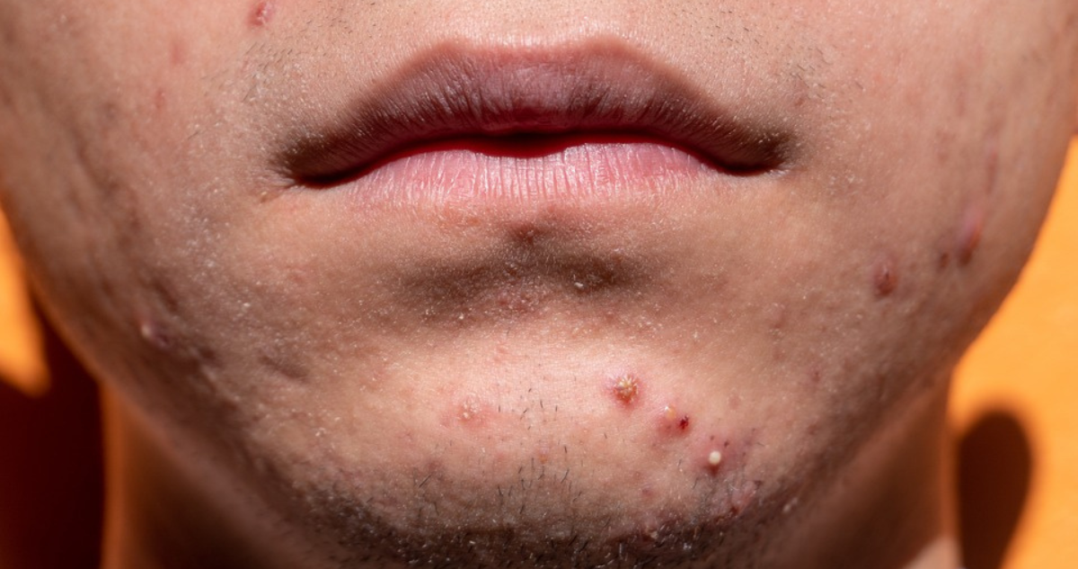 ¿Sirve realmente la pasta de dientes para eliminar las espinillas? Esto dicen dermatólogos