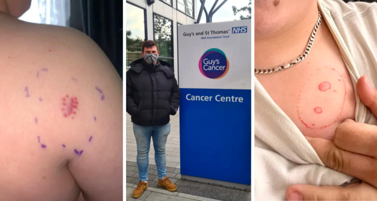 Un joven inglés pensó que había sufrido una reacción alérgica tras mantener comezón en una parte de su cuerpo, pero en realidad su diagnóstico era cáncer.Un joven inglés pensó que había sufrido una reacción alérgica tras mantener comezón en una parte de su cuerpo, pero en realidad su diagnóstico era cáncer.