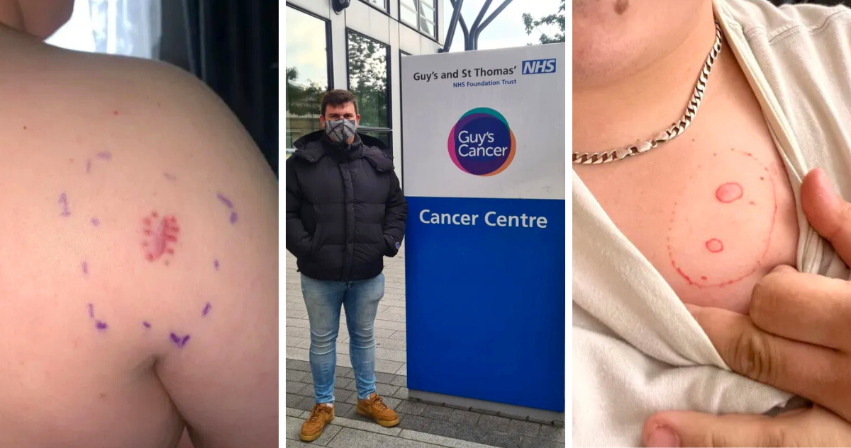 Un joven inglés pensó que había sufrido una reacción alérgica tras mantener comezón en una parte de su cuerpo, pero en realidad su diagnóstico era cáncer.Un joven inglés pensó que había sufrido una reacción alérgica tras mantener comezón en una parte de su cuerpo, pero en realidad su diagnóstico era cáncer.