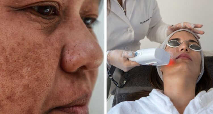 Cuántos tipos de manchas en la cara o el rostro existen, cómo combatirlas, por qué se producen y qué tratamientos dermatológicos estéticos hay,