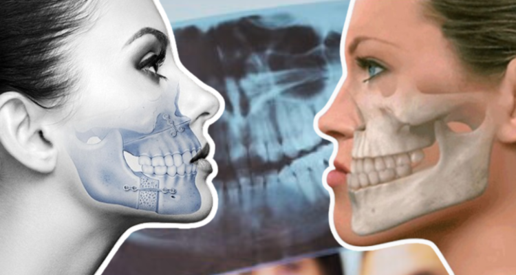 ¿Qué es una anomalía dentofacial? La deformación ósea que afecta el desarrollo de la mandíbula