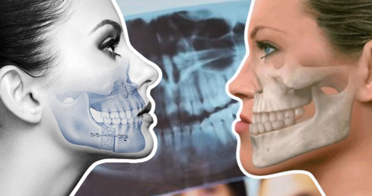 ¿Qué es una anomalía dentofacial? La deformación ósea que afecta el desarrollo de la mandíbula