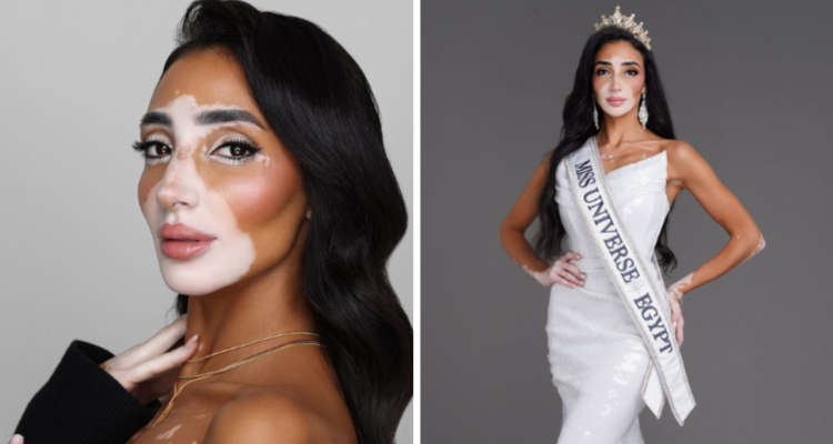 Miss Egipto será la primera aspirante a Miss Universo con vitiligo.