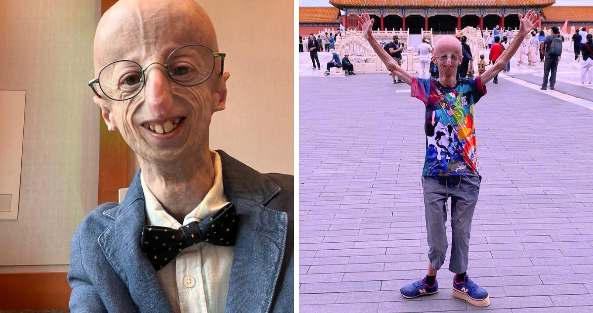 Muere Sammy Basso, el hombre que visibilizó la enfermedad genética que lo envejecía prematuramente