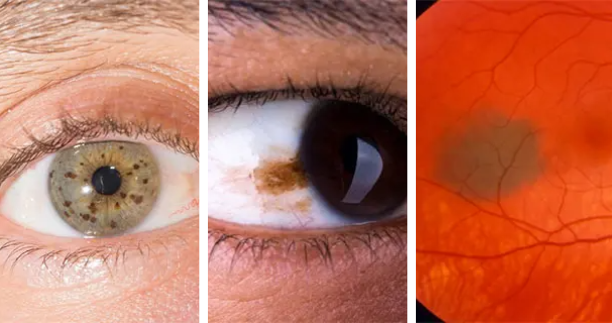 Melanoma ocular