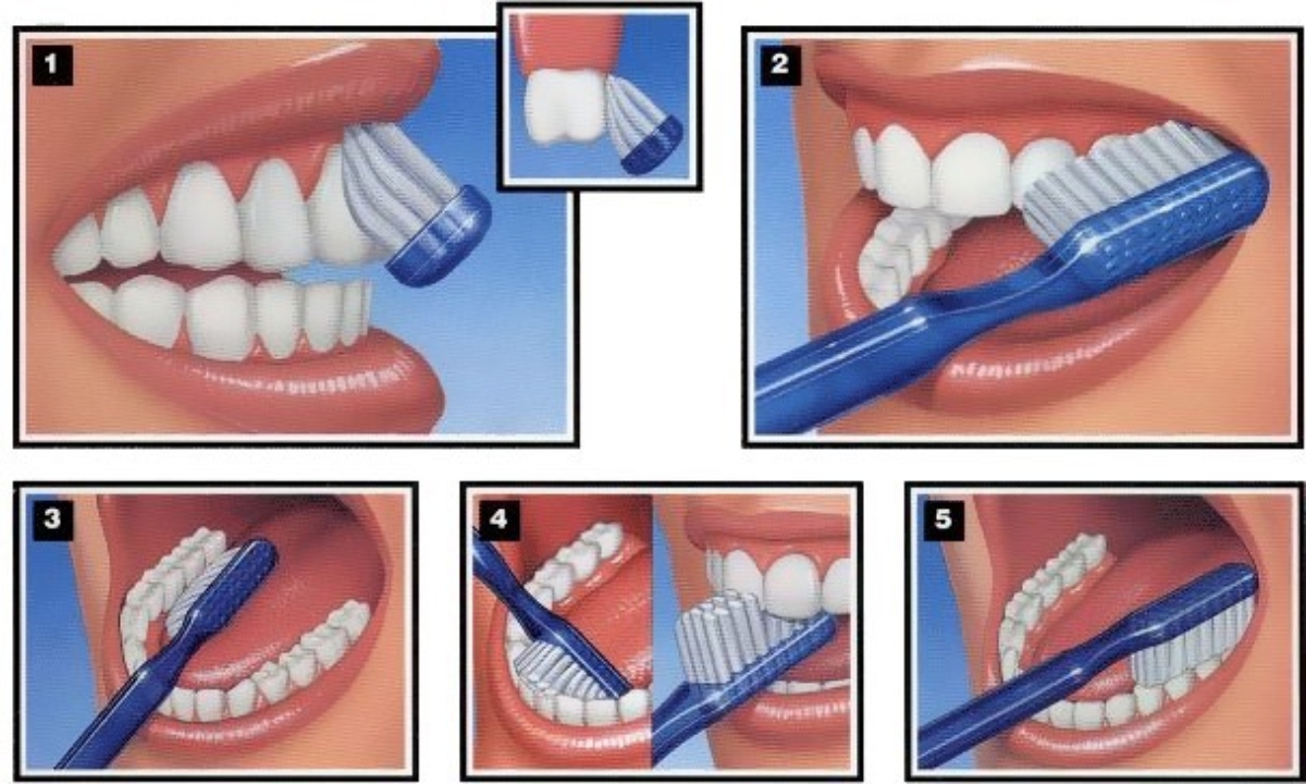 Técnicas para cepillado dental