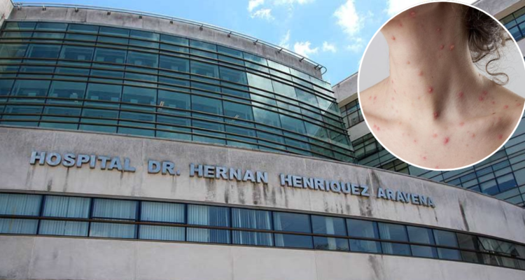 Dos estudiantes de escuela en Tirúa en riesgo vital por varicela: hay otros 6 niños infectados