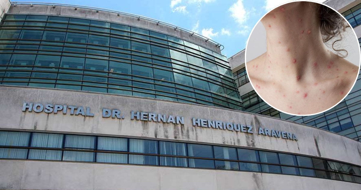 Dos estudiantes de escuela en Tirúa en riesgo vital por varicela: hay otros 6 niños infectados