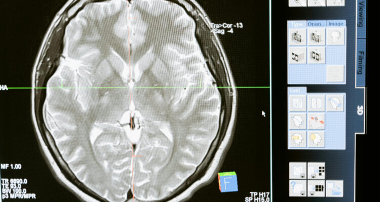 Imagen cerebral para ilustrar el método con IA que identifica restos de tumores en el cerebro