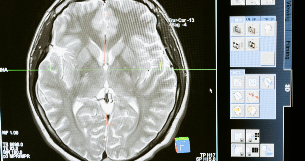 Imagen cerebral para ilustrar el método con IA que identifica restos de tumores en el cerebro