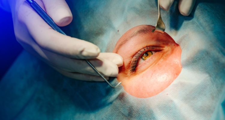 Cirugía para cambiar el color de los ojos