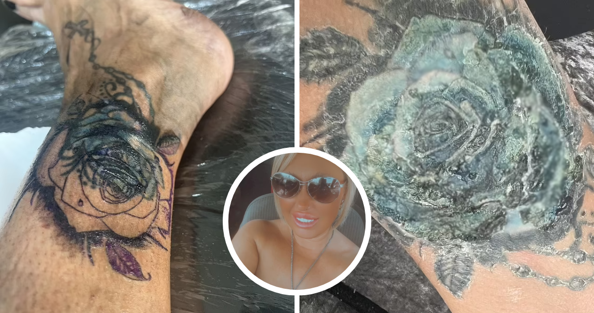 Mujer casi pierde su pie tras realizarse un tatuaje que le provocó una celulitis infecciosa en Turquía