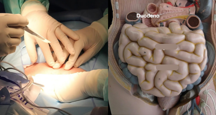 Hombre vivía con el intestino dentro de su pierna