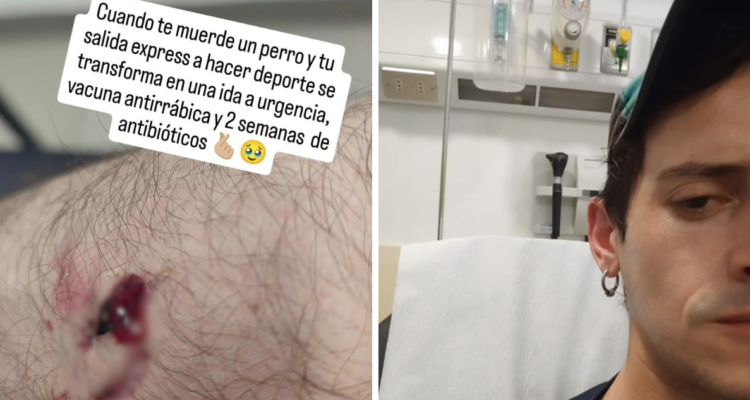 Actor, José Antonio Raffo, debió acudir a urgencias tras ataque de un perro mientras hacía deporte