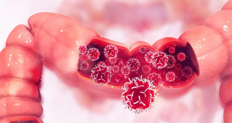 Estudio afirma que el cáncer colorrectal sigue en aumento para las personas menores de 50 años