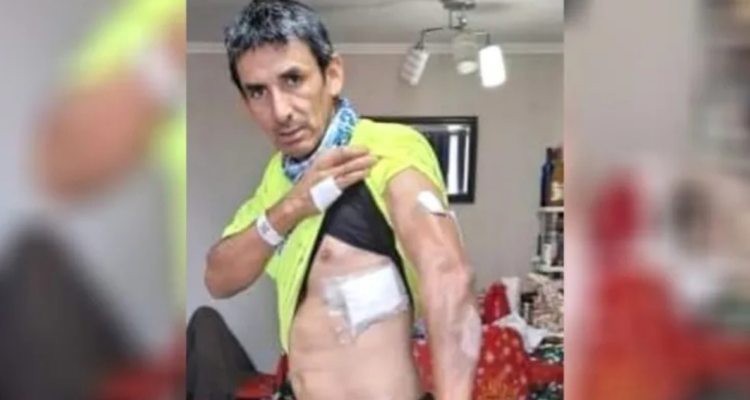 hombre mordido por perros en ovalle