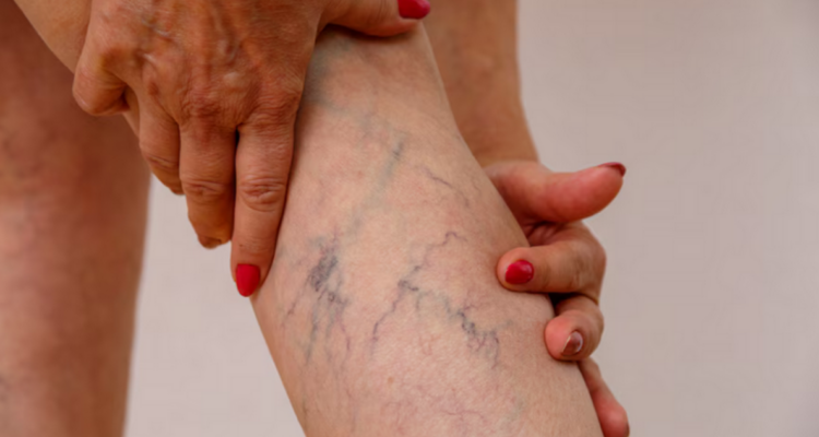¿Las várices solo se presentan en adultos mayores? Derribando mitos sobre esta condición médica