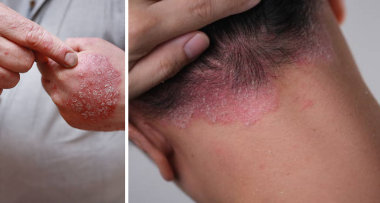 Psoriasis: causas y tratamiento para la enfermedad que provoca escamas y heridas en la piel