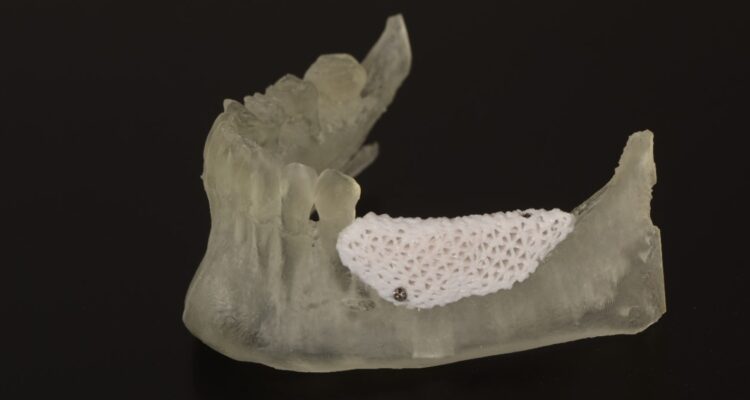 Restaurar huesos para implantes dentales: prototipo inédito en Sudamérica