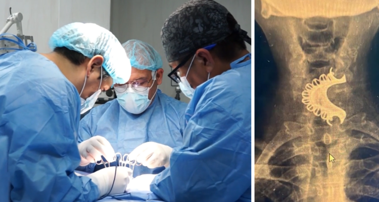 Adulto mayor de 81 años se tragó su dentadura postiza por accidente en Perú: la tuvo cuatro días