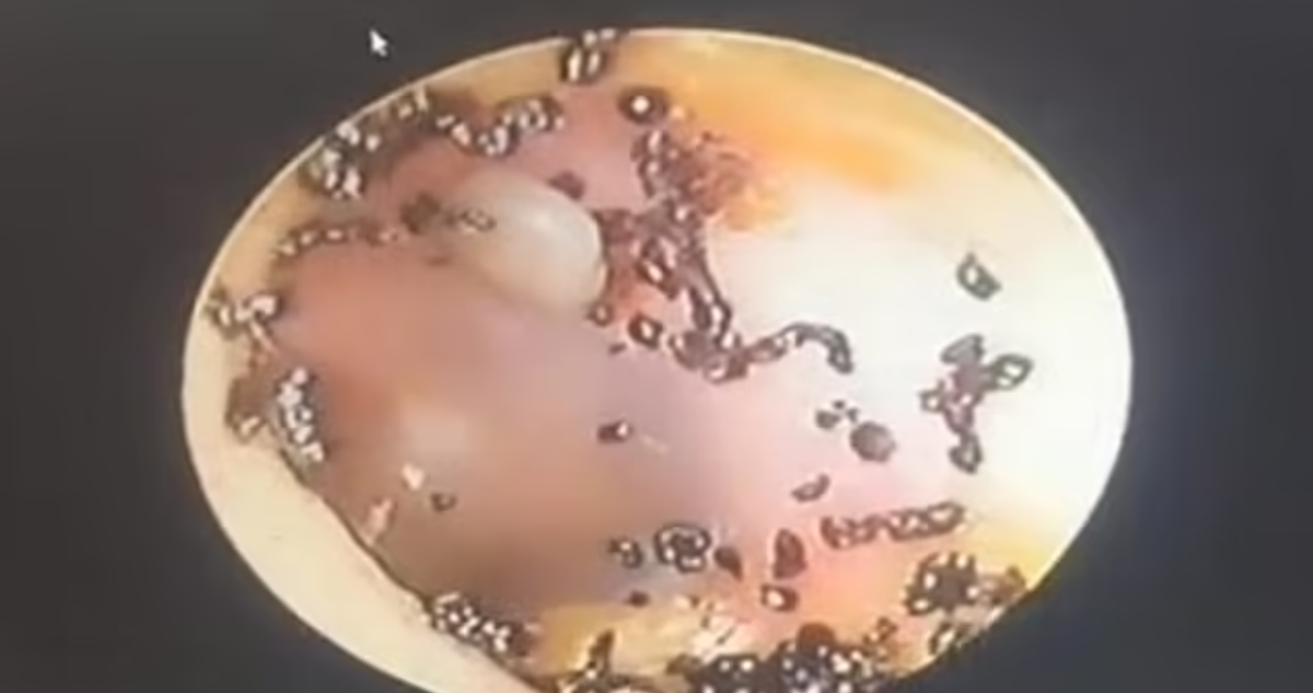 Garrapatas en el oído