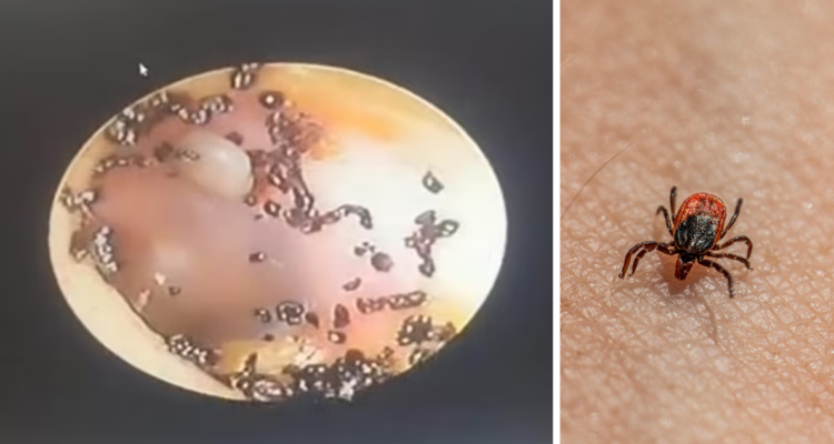 Médico descubre garrapatas en el oído de niña en Malasia: menor sintió dolor durante semanas