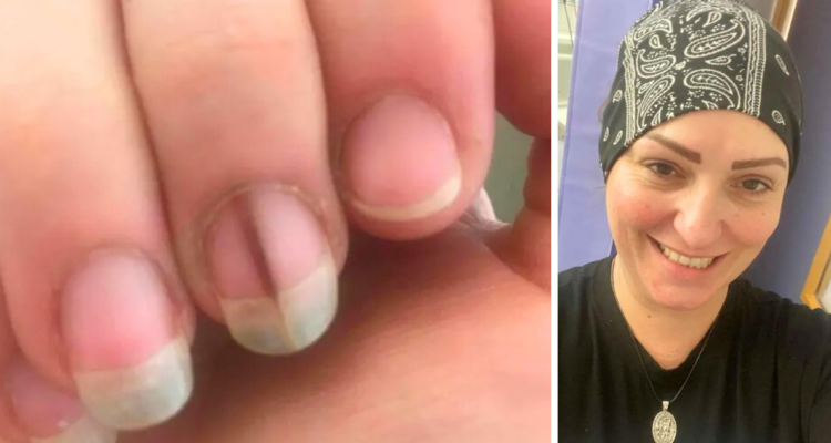 Mancha en dedo de una mujer fue el inicio de un complejo cáncer