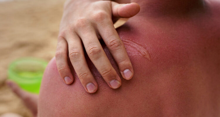 Qué hacer ante una quemadura causada por el sol y cuándo debes acudir al médico