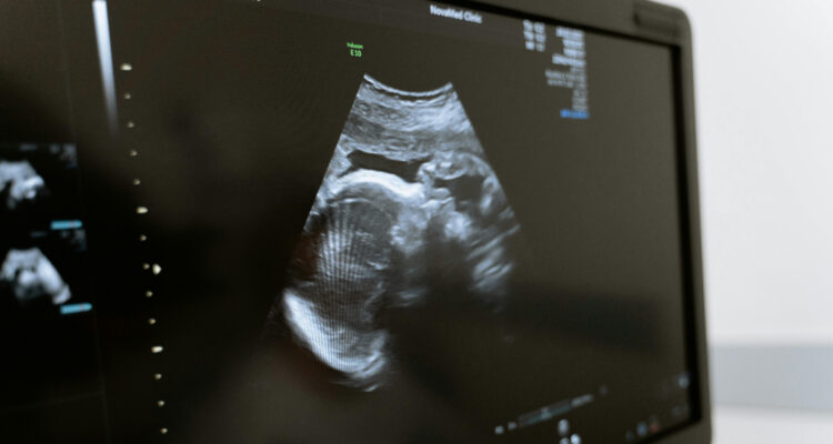 Tratan por primera vez una enfermedad genética mortal a un feto mientras estaba dentro del útero