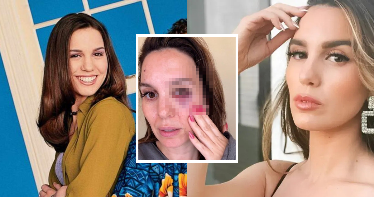 Casi perdió un ojo: Ex estrella Disney recibió un disparo en pleno rostro durante una fiesta familiar