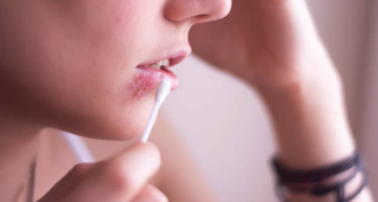 ¿Se pueden eliminar los “fuegos” en los labios? Esto dicen los especialistas sobre el herpes