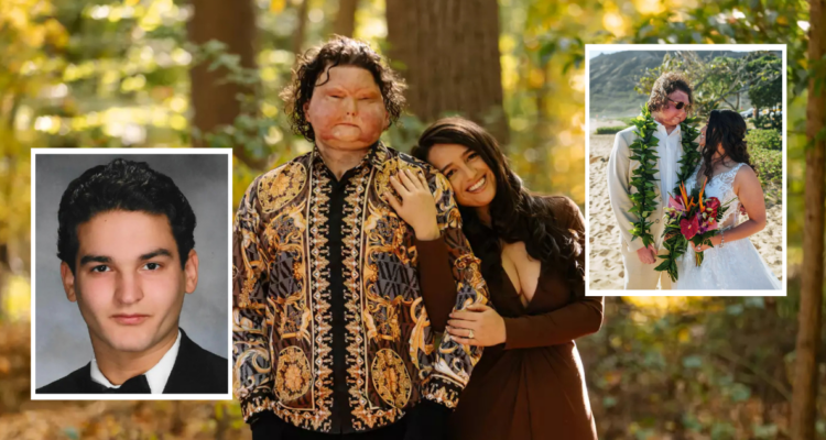 Joven que recibió trasplante de rostro y manos en EEUU se casó con enfermera que conoció en Instagram