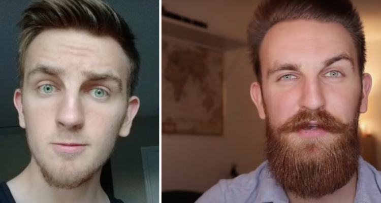 Adolescentes y jóvenes no deberían usar minoxidil: las “gotas milagrosas” que hacen que te salga barba