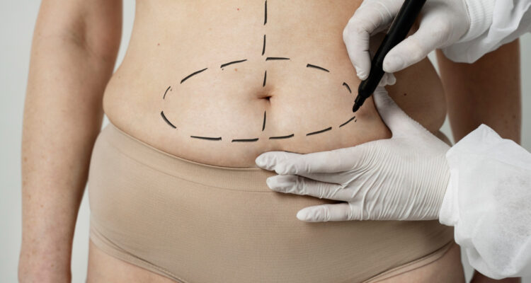 Bono PAD ahora incluye abdominoplastía