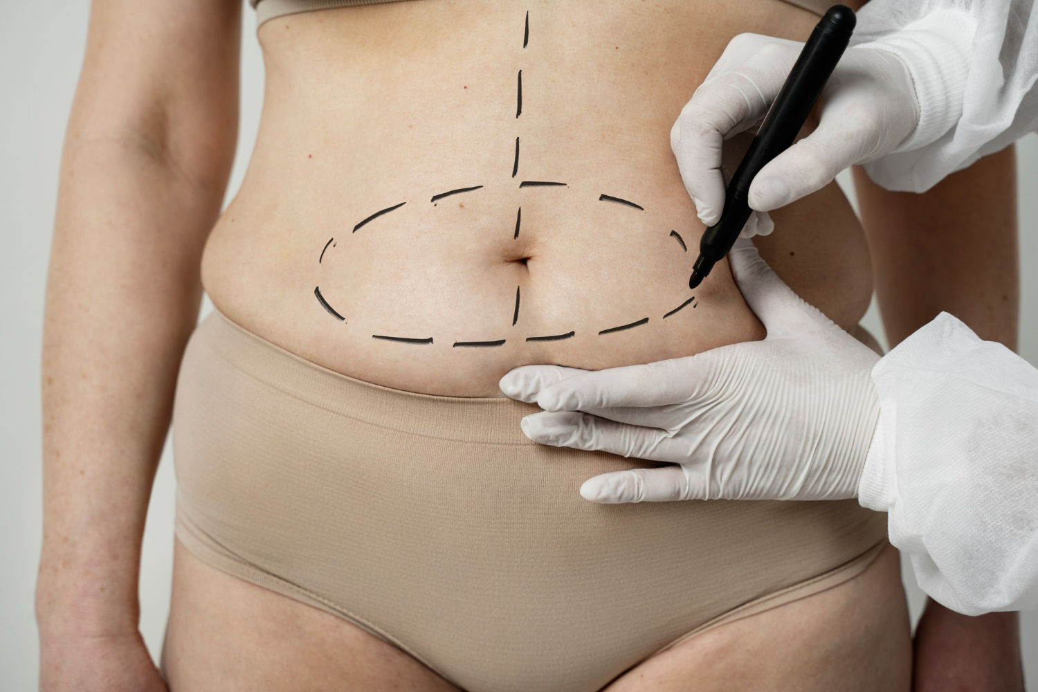 Bono PAD ahora incluye abdominoplastía
