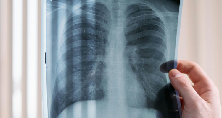 ¿Cómo prevenir la tuberculosis? La enfermedad infecciosa que causa graves efectos en el organismo