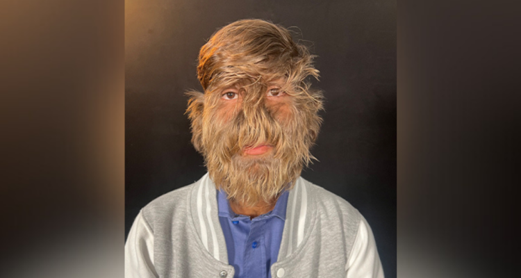 Joven de 18 años obtiene el récord Guinness por ser la persona con el rostro más peludo del mundo