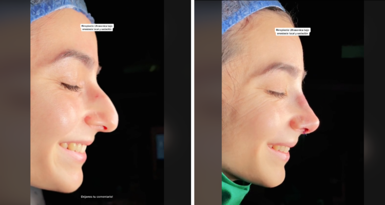 Cirujano advierte que el 95% de las fotos del antes y después de cirugías plásticas no son fidedignas