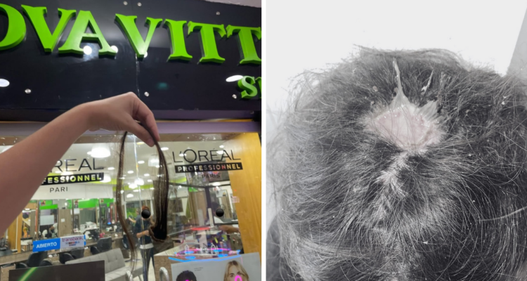 Experta explica por qué joven terminó con quemadura y mechón desprendido tras decoloración en Quilpué