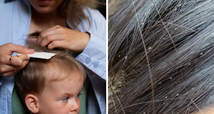 No más piojos ni liendres: todo lo que debes saber para evitar contagios en la vuelta al colegio