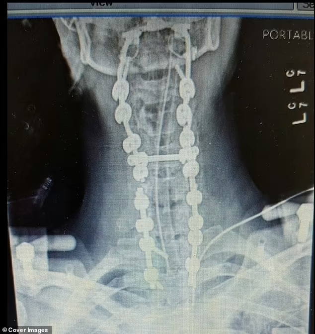 Mujer sufre "decapitación" interna y médicos le reimplantaron el cráneo: queda como estatua humana
