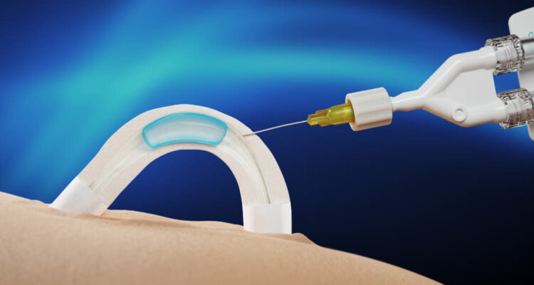 Implante anticonceptivo para hombres