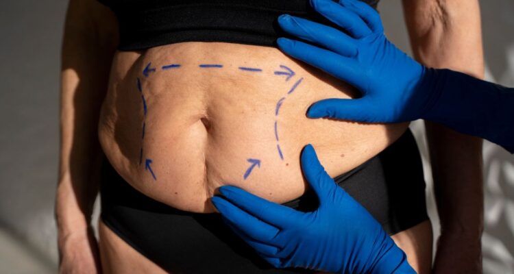 Qué es el Bono PAD, cuáles son los requisitos, cómo obtener o cuánto vale el valor para cirugía bariátrica de bypass o manga gástrica.